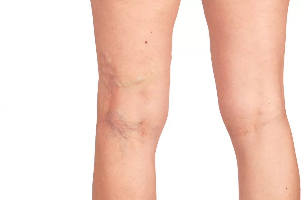 Sclerotherapy for Varicose Veins and Spider Veins in Los Angeles & Walnut, CA