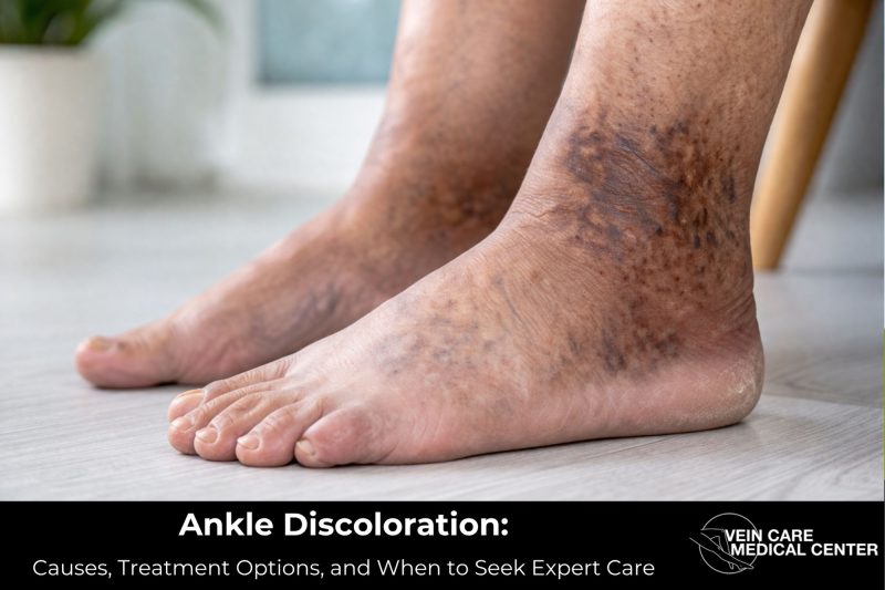 Ankle Discoloration: Causes, Treatment Options, and When to Seek Expert Care