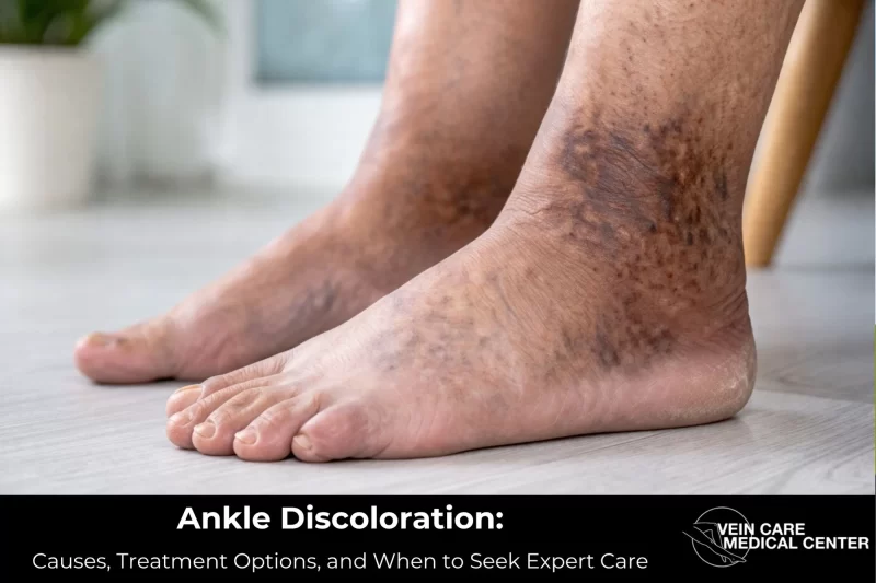 Ankle Discoloration: Causes, Treatment Options, and When to Seek Expert Care