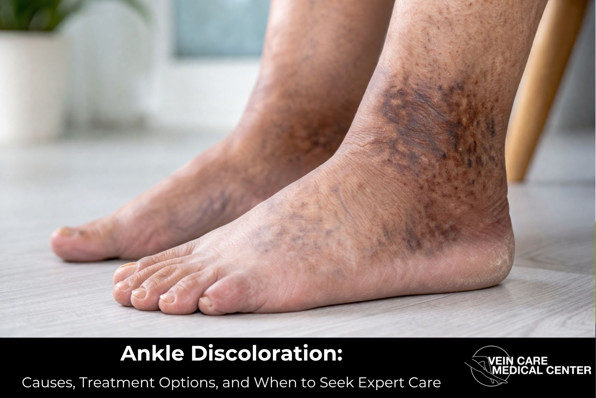 Ankle Discoloration: Causes, Treatment Options, and When to Seek Expert Care