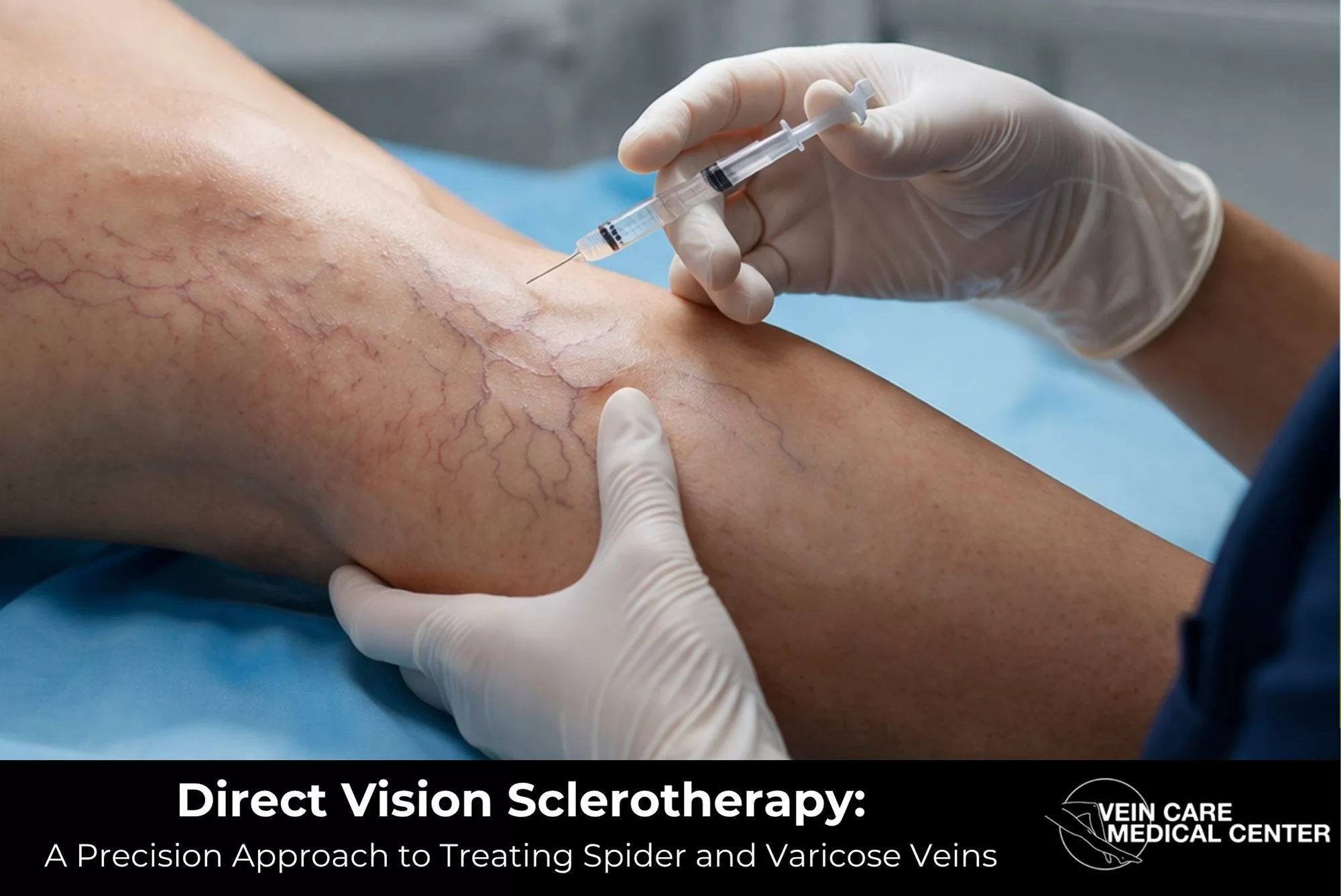 Direct Vision Sclerotherapy: A Precision Approach to Treating Spider and Varicose Veins