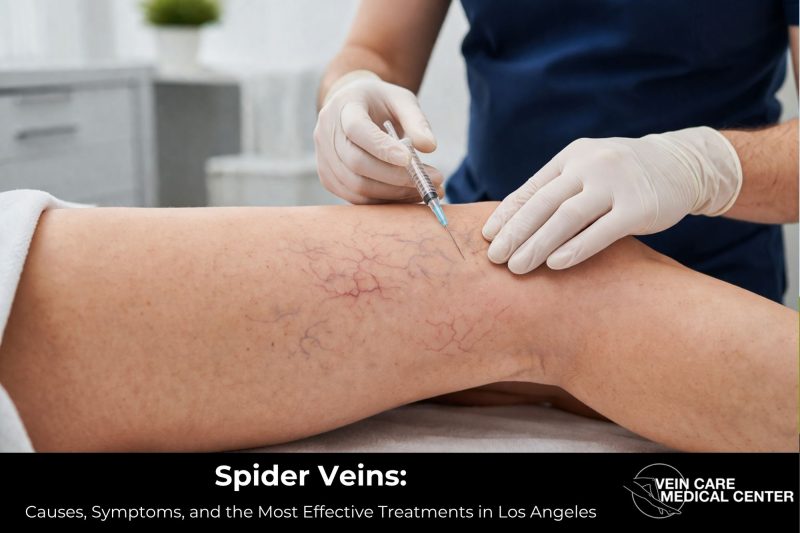 Spider Veins: Causes, Symptoms, and the Most Effective Treatments in Los Angeles